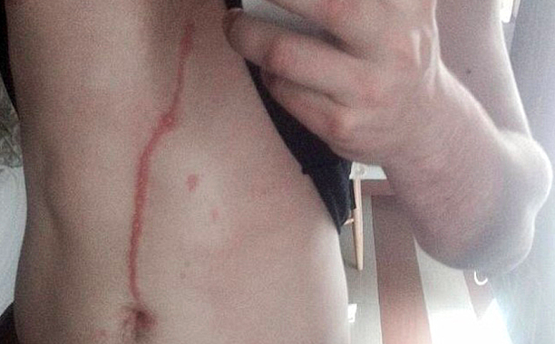 Dylan Thomas’ “gnarly scar”.