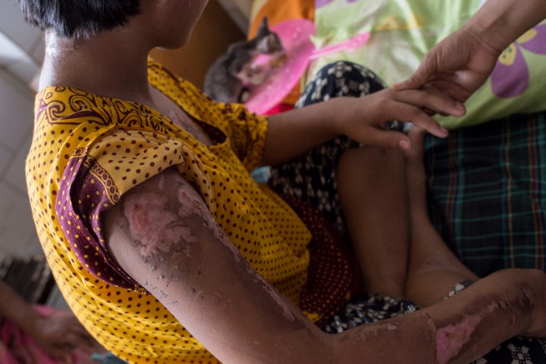 EDITORS NOTE: Graphic content / This picture taken on June 6, 2017, shows Myat Noe, whose name has been changed to protect her identity, with burns on her arm in the Sanpya hospital in Yangon.
Playing with a tiny kitten is the only thing that stops 13-year-old Myat Noe crying as she lies in a Yangon hospital, flesh peeling from where she says her employers burned her with irons and boiling water. She was rescued last weekend from a house south of Myanmar’s commercial capital where she was sent to work as a live-in housemaid earning less than $10 a week. Her story is one many child domestic helper abuse cases to emerge since the country’s first freely elected government in half a century took power last year.  / AFP PHOTO / Ye Aung Thu