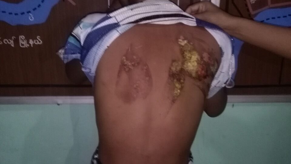 Khine Hnin Wai had burn marks on her chest, back, arms, and thighs. Photo: Yangon Police