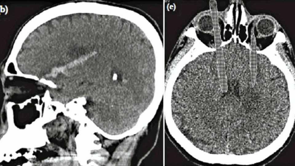 A recreation of the patient’s CT scan, which was published in the latest issue of the Hong Kong Medical Journal.