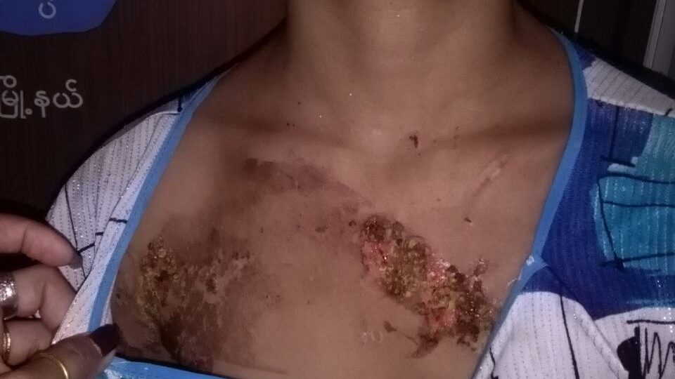 Injuries inflicted on a 13-year-old domestic helper by her employers. Photo: Yangon Police
