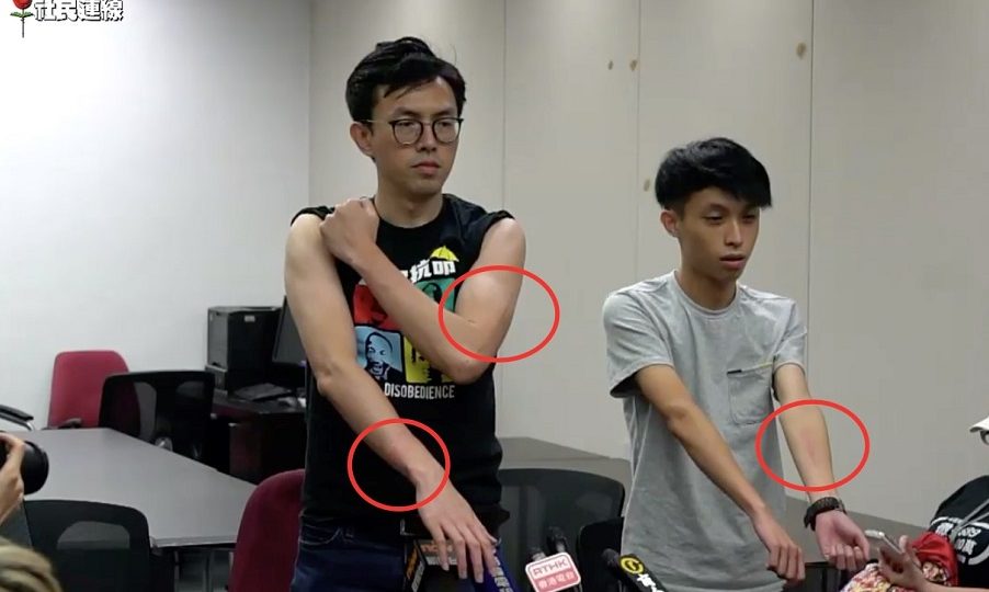 League of Social Democrats Chairperson Avery Ng (L) and party member Figo Chan (R) showing what they say are police-inflicted injuries to reporters. Screenshot: League of Social Democrats via Facebook