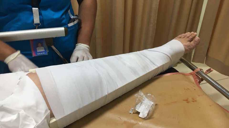 A Dutch tourist named Marion suffered two fractures on her left leg after falling in a hole on a sidewalk in Bandung, West Java on October 3, 2017. Photo: Facebook/Sazkia Rosseina Gaziscania