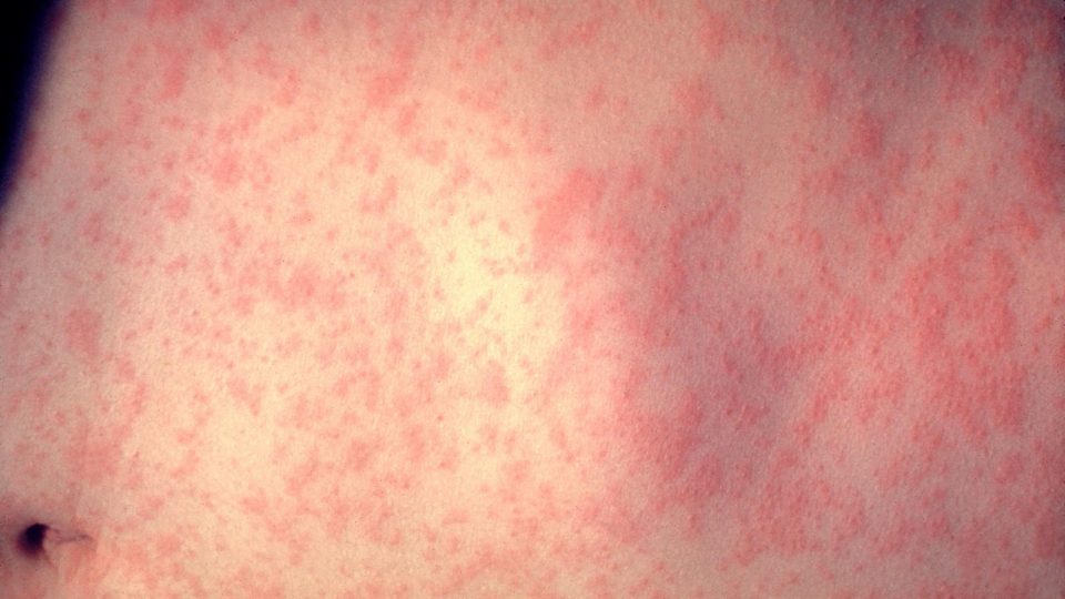 Skin with measles. PHOTO: CDC/Dr. Heinz F. Eichenwald via Wikipedia