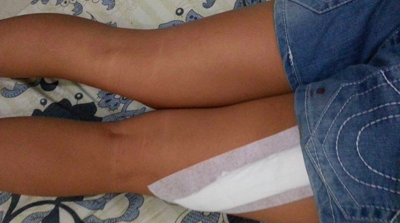 Sadly, this isn’t the first incidence of random leg-slashing in Bali. This photo went viral after it was posted in December 2015 by another woman who fell victim to a similar assault. Photo via Facebook