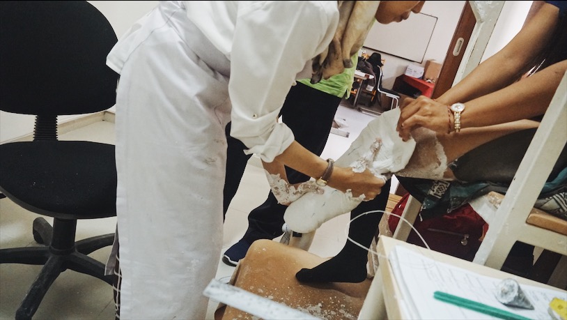 Plaster gets wrapped around Kariani's stump to make a negative cast for her prosthetic in Puspadi Bali on Jan. 25, 2019. Photo: Julianne Greco/Coconuts Bali