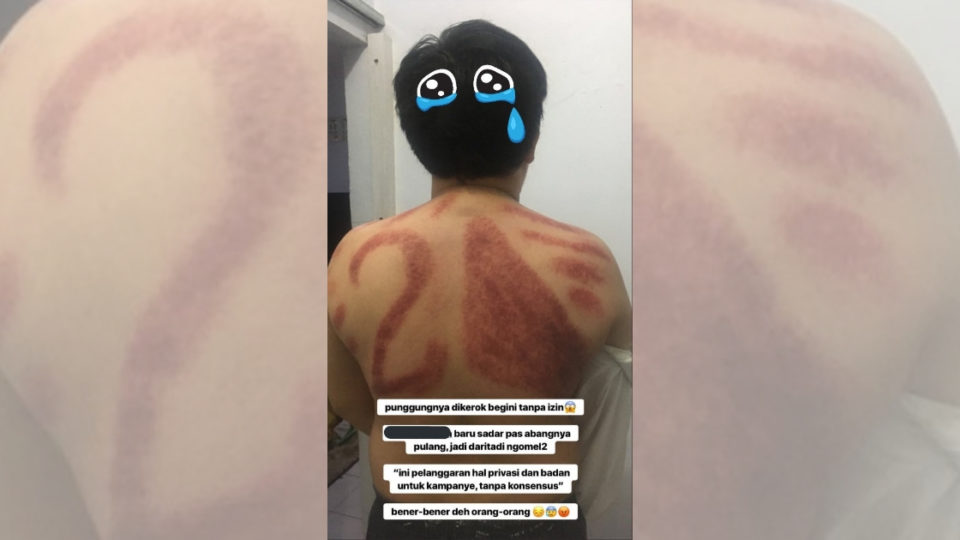 The male masseuse who performed the kerokan on Aida’s brother was allegedly a “fanatic supporter” of presidential candidate Prabowo Subianto and his running mate Sandiaga Uno, that he made sure to leave a conspicuous memento on his client’s back. Photo: Instagram/@aidaazharr