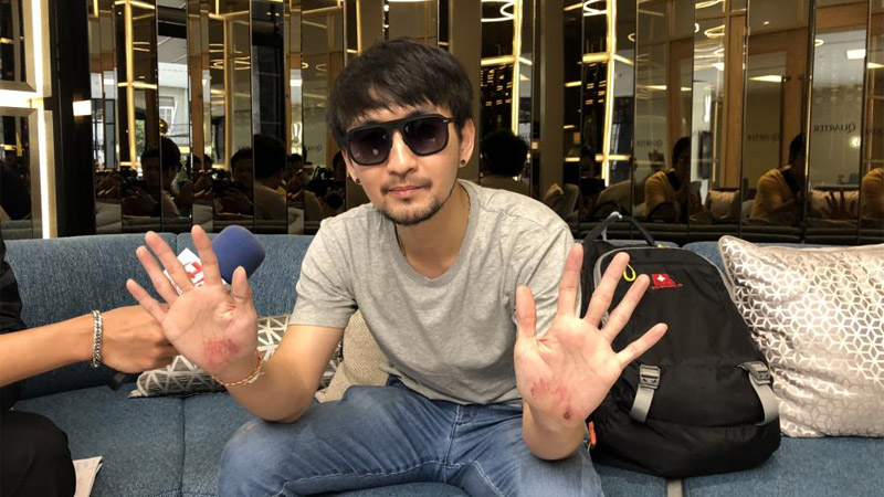 A very sad Naset Taweepisitkun displays his scuffed hands today in Bangkok.