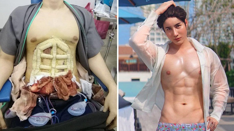 Model Ome Pangpaparn during and after the surgery. Photo: Masterpiece Hospital/ Facebook and Ome Pangpaparn/ Instagram