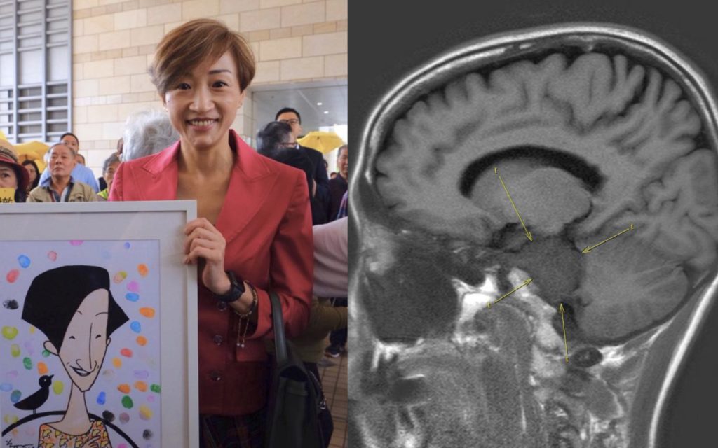 Civic Party lawmaker Tanya Chan (left) outside West Kowloon Magistrates Court after being found guilty of public nuisance charges related to the 2014 Umbrella movement, and an MRI scan she posted on Facebook. Photos via Facebook/Tanya Chan.