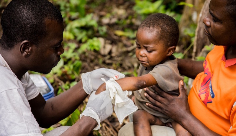 A child affected by monkeypox, sits on his father’s legs while receiving treatment at the centre of the International medical NGO Doctors Without Borders (Medecins sans frontieres – MSF), in Zomea Kaka, in the Lobaya region, in the Central African Republic on October 18, 2018. Monkeypox is a contagious disease, without remedy, which heals itself, but can kill if not treated in time. Since May 2018, the monkeypox virus, which spreads in tropical Africa, has become a “public health threat” in the Central African Republic, according to the Pasteur Institute of Bangui. Photo: CHARLES BOUESSEL/AFP
