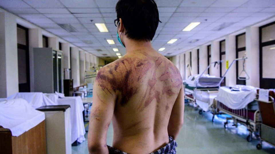 Calvin So, 23, a resident of of Yuen Long, shows his wounds and bruises in a hospital corridor in Hong Kong after he was assaulted on his way home from work on July 21. Photo via AFP.