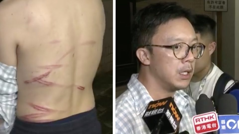 Max Chung shows reporters the scars on his back sustained from an attack by four masked men in Tai Po on Thursday afternoon. Screengrabs via Facebook/RTHK.