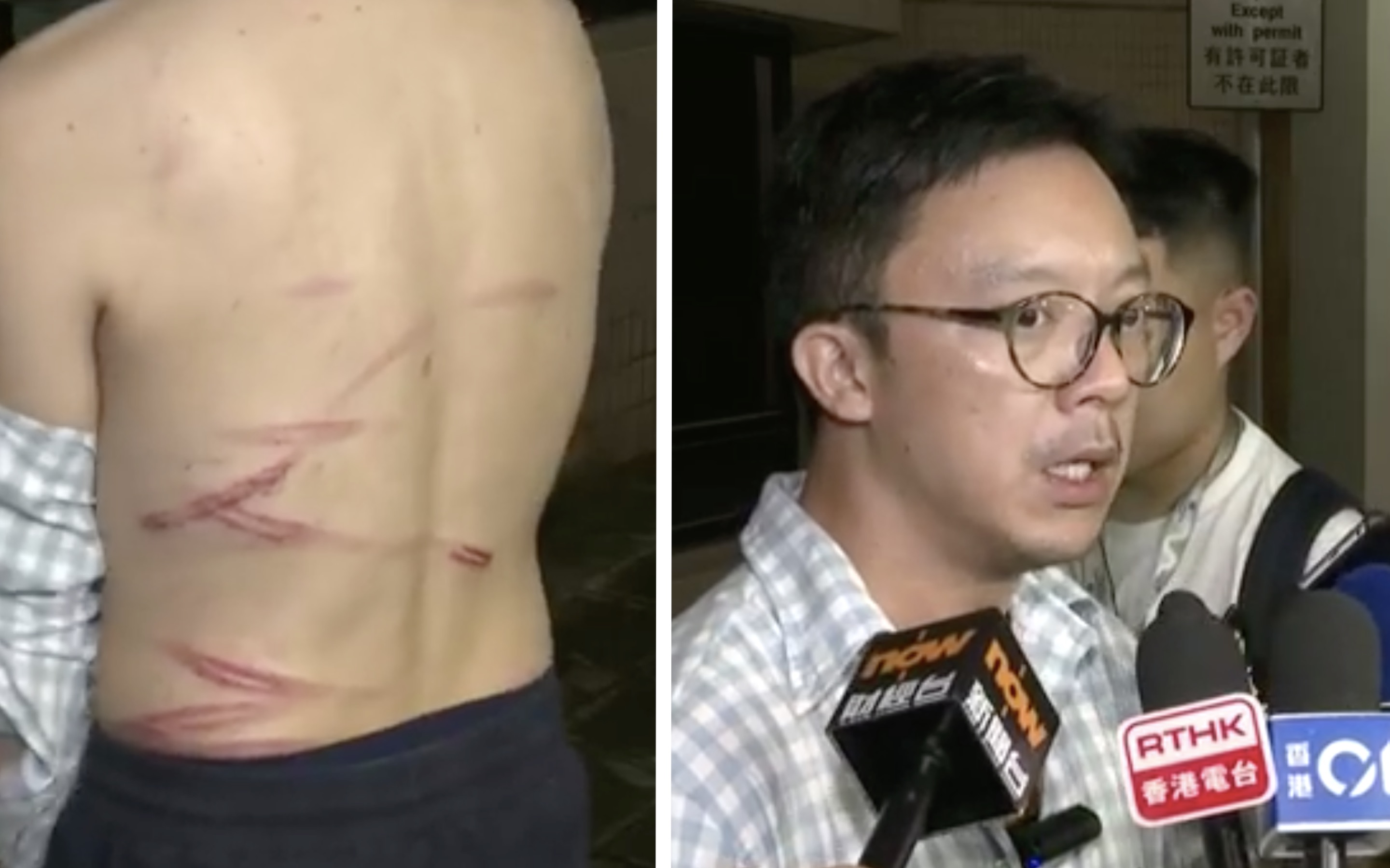 Max Chung shows reporters the scars on his back sustained from an attack by four masked men in Tai Po on Thursday afternoon. Screengrabs via Facebook/RTHK.