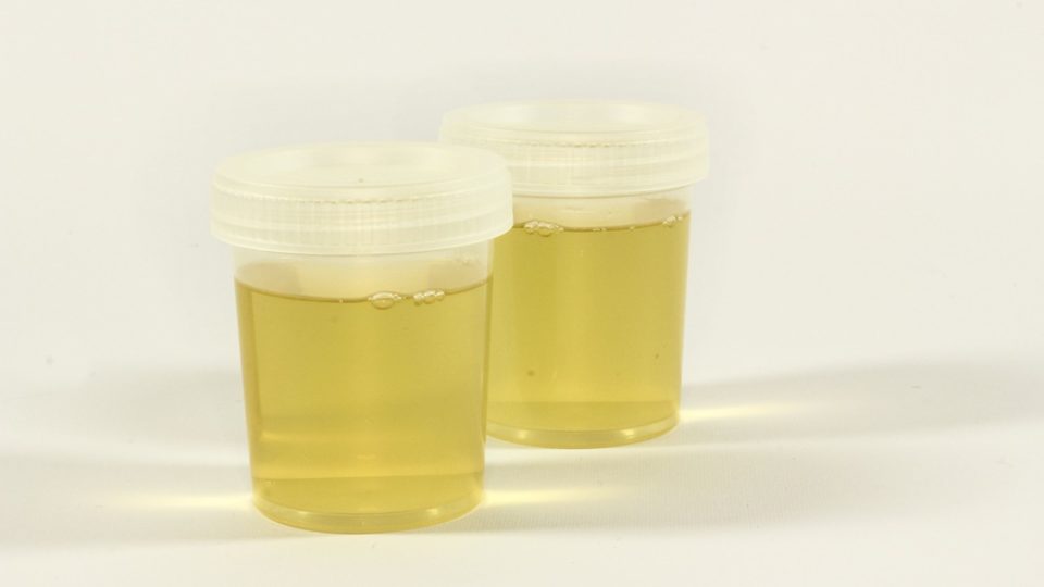File photo of urine sample. Image: Ewa Urban