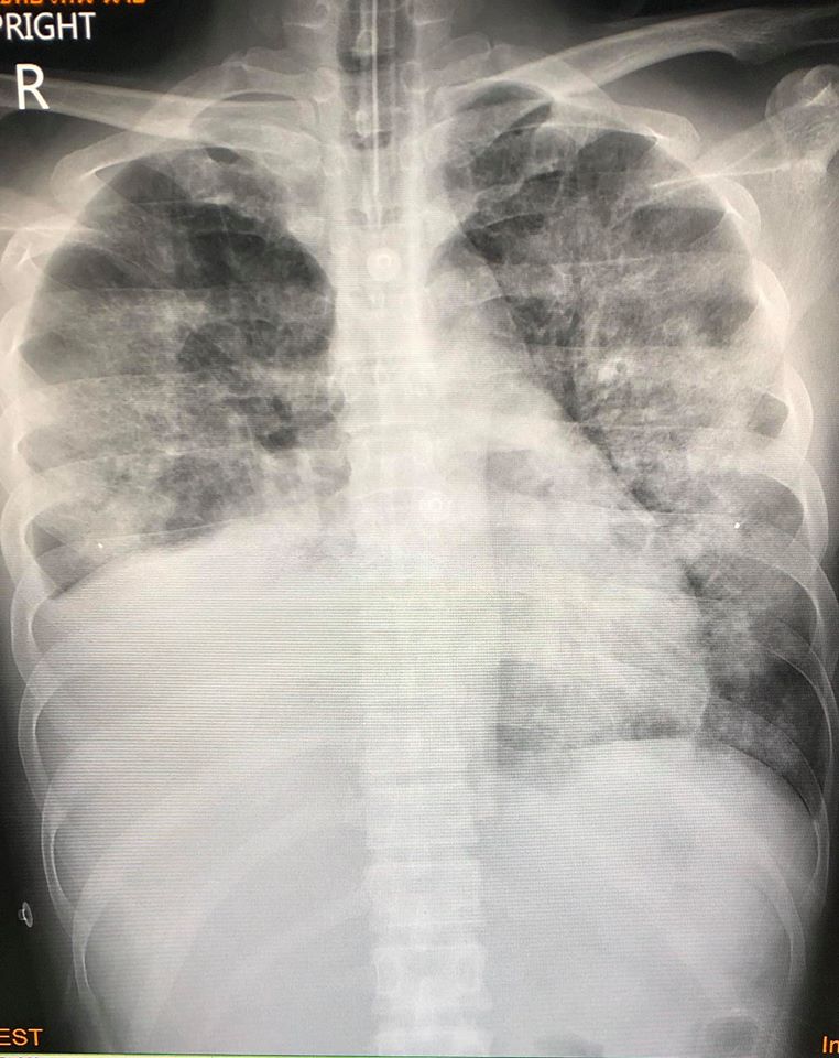 An x-ray of the patient’s lungs. Photo: Dr. Manoon Leechawengwongs / Facebook