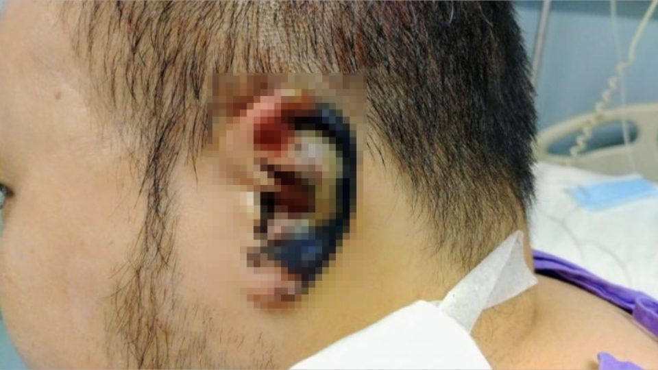 Democratic Party district councillor Andrew Chiu posted on Facebook that doctors have to remove his reattached ear because of cell tissue damage. Photo via Facebook/Democratic Party.