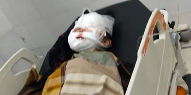 An 8-year-old Indonesian girl, identified by her initial M, being treated in hospital following a pit bull attack. Photo: Istimewa