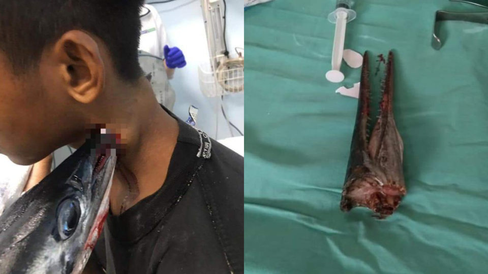 A 16-year-old boy named Muhammad Idul from Wakinamboro village in the South Buton regency of Southeast Sulawesi miraculously survived after a needlefish speared him in the neck with its snout when he went fishing on Saturday night. Photos: Istimewa
