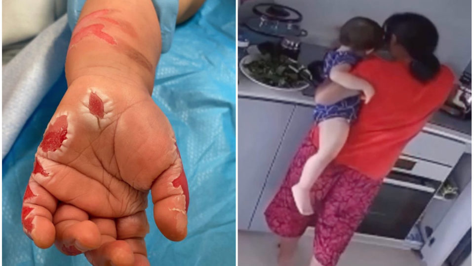 Photo of purported burns on toddler’s hand, at left, the alleged maid caught on video dipping toddler’s hand in hot pot. Images: Amy Low Mei Liang/Facebook