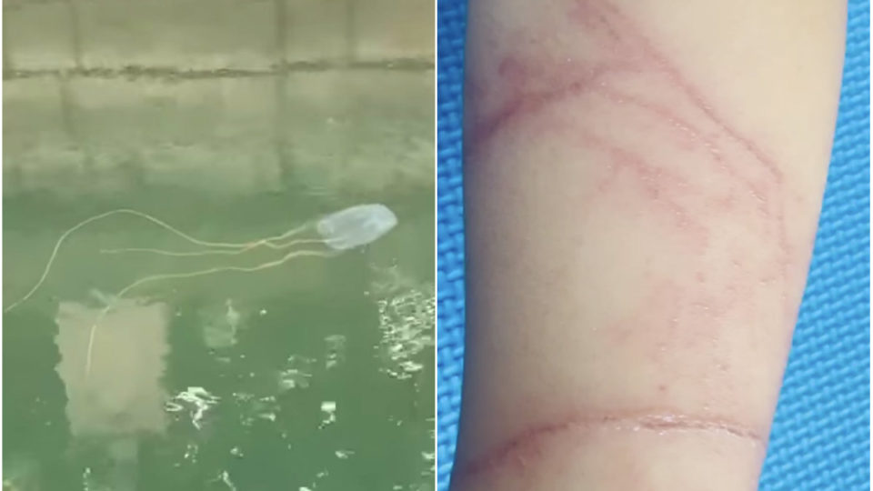 At left, the Box Jellyfish spotted at Sentosa, scars from an attack, at right. Images: Marine Stewards/Facebook, Carolyn David/Facebook
