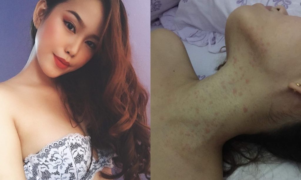 A recent photo of Vanessa Mae Lim (right) and Lim’s neck covered with rashes caused by a skin-whitening product two years ago (right). Photos: Vanessa Mae Lim