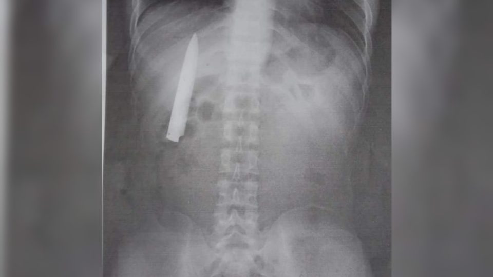 The knife stuck in Kent Ryan Tomao’s chest. Photo from Tomao