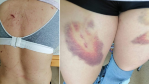 Eden, a domestic worker from the Philippines, sustained deep bruises and injuries on her body at the hands of her abusive employer. Photo: Facebook/Asian Migrants Coordinating Body