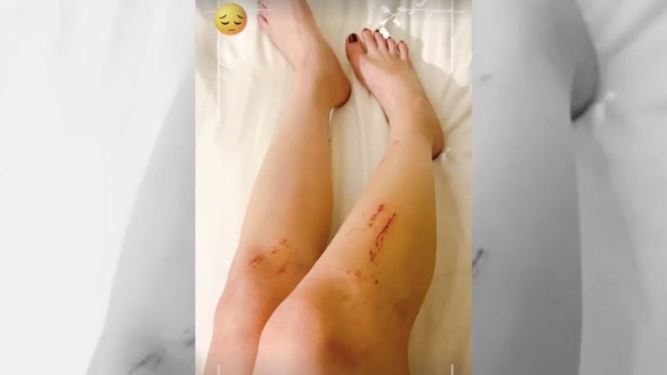 Influencer Ayu Thalia posted a story on Instagram showing minor wounds on her legs after she reported Nicholas Sean Purnama to the police for assault. Photo: Instagram/@thata_anma