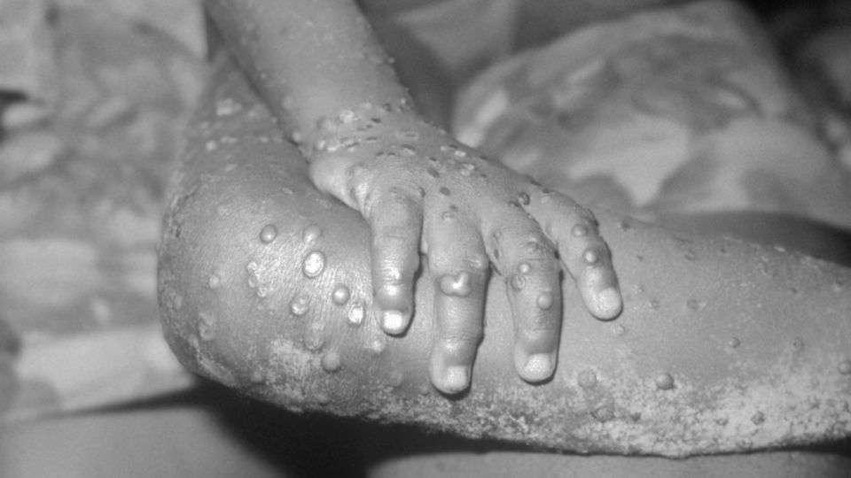 File photo of a monkeypox infection.