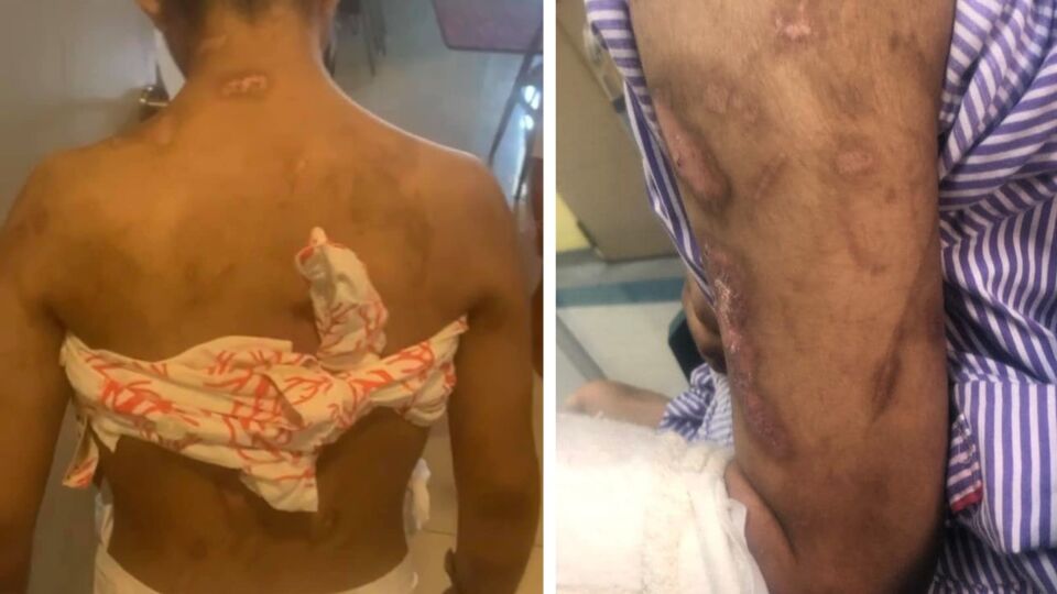 Scars throughout the body of Bella who was allegedly abused by Siti Bainun in 2021.Photos: Mona Din / Facebook
