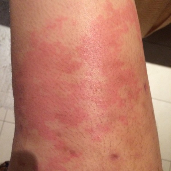 Claudine Barretto has urticaria