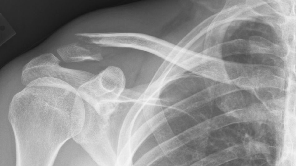 An X-Ray scan of a broken bone. Photo: Flickr